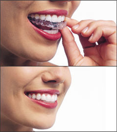 A woman placing in her Invisalign aligners