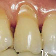 Image of teeth with abfraction lesions