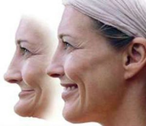 before and after facial collpase