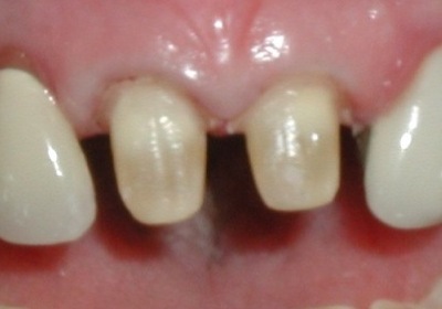 Image of tooth preparation for dental crowns