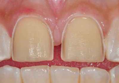 Image of teeth prepared for porcelain veneers