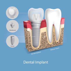 diagram of a dental implant next to a natural tooth