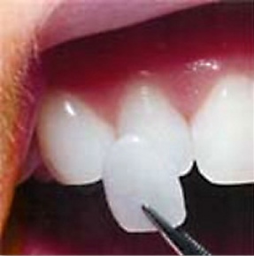 a porcelain veneer being held up to a tooth