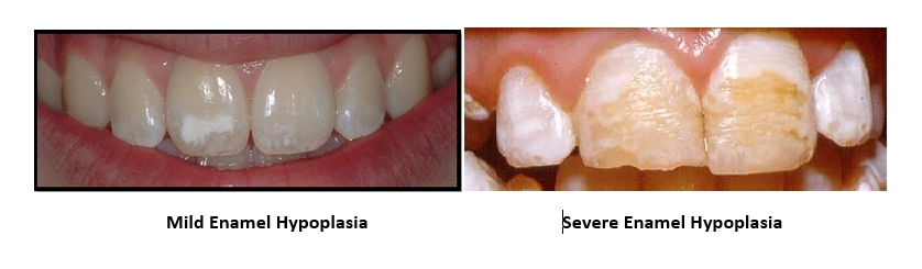 An image with two examples of enamel hypoplasia