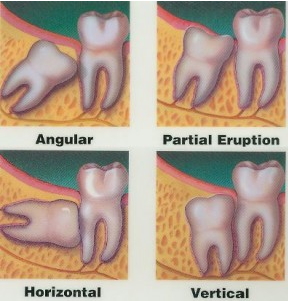 Image of impacted wisdom teeth