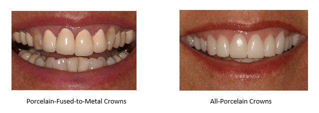 comparing metal backed crowns to all-porcelain crowns