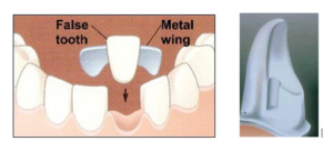 Maryland Bridge diagram