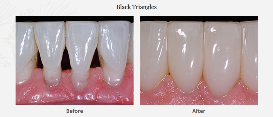 Treatment of black triangles