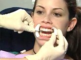 Lafayette Zoom whitening - a photo of retractors being placed on a patient