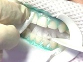 Lafayette Zoom whitening - a photo of green gel being placed on patient's teeth, with retractors holding back the lips and a paper towel over the lips.
