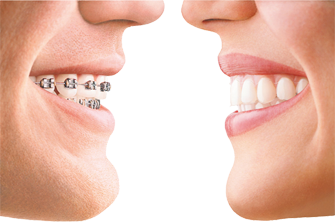 Invisalign compare with traditional braces