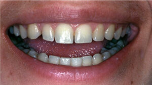 anne-smile-before