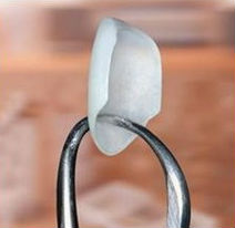 A single porcelain veneer being held up by a dental tool
