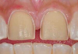 Lafayette Porcelain Veneers