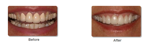 A ugly cosmetic smile and a pretty cosmetic smile
