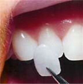 Porcelain Veneer being placed on a tooth