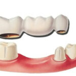 Illustration of a dental bridge