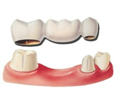 Illustration of a dental bridge