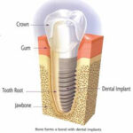Dental Implant Diagram