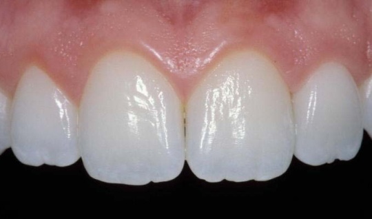 Dental work with all natural teeth but one