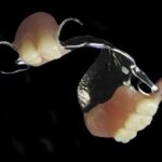 Removable Partial Denture