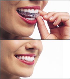 Image top: A woman putting on her Invisalign aligners. Image bottom: a woman smiling with Invisalign on her teeth