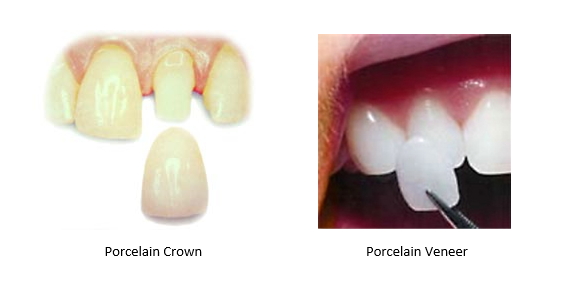 Porcelain crown on left and porcelain veneer on right