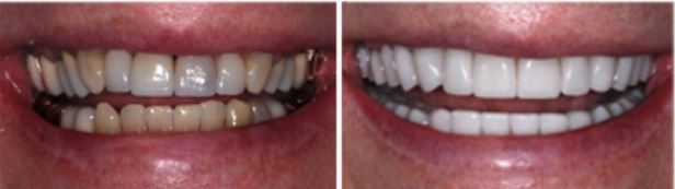 Before-and-after porcelain crowns photo of a patient's smile.