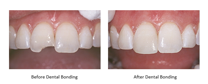 a before and after picture of dental bonding for a chipped tooth.