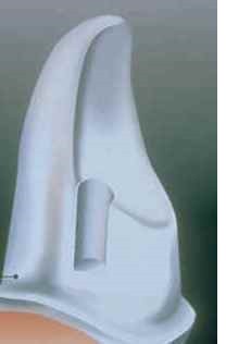 tooth preparation for a Maryland Brdige