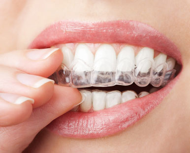 Woman placing teeth whitening trays on her teeth