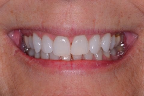 An up-close photo of a Lafayette, LA patient's gummy smile after a Botox treatment. The patient's upper lip is now relaxed and covering her gums.