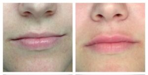 beore and after Juvederm