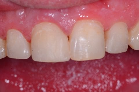 Fractured tooth after dental bonding