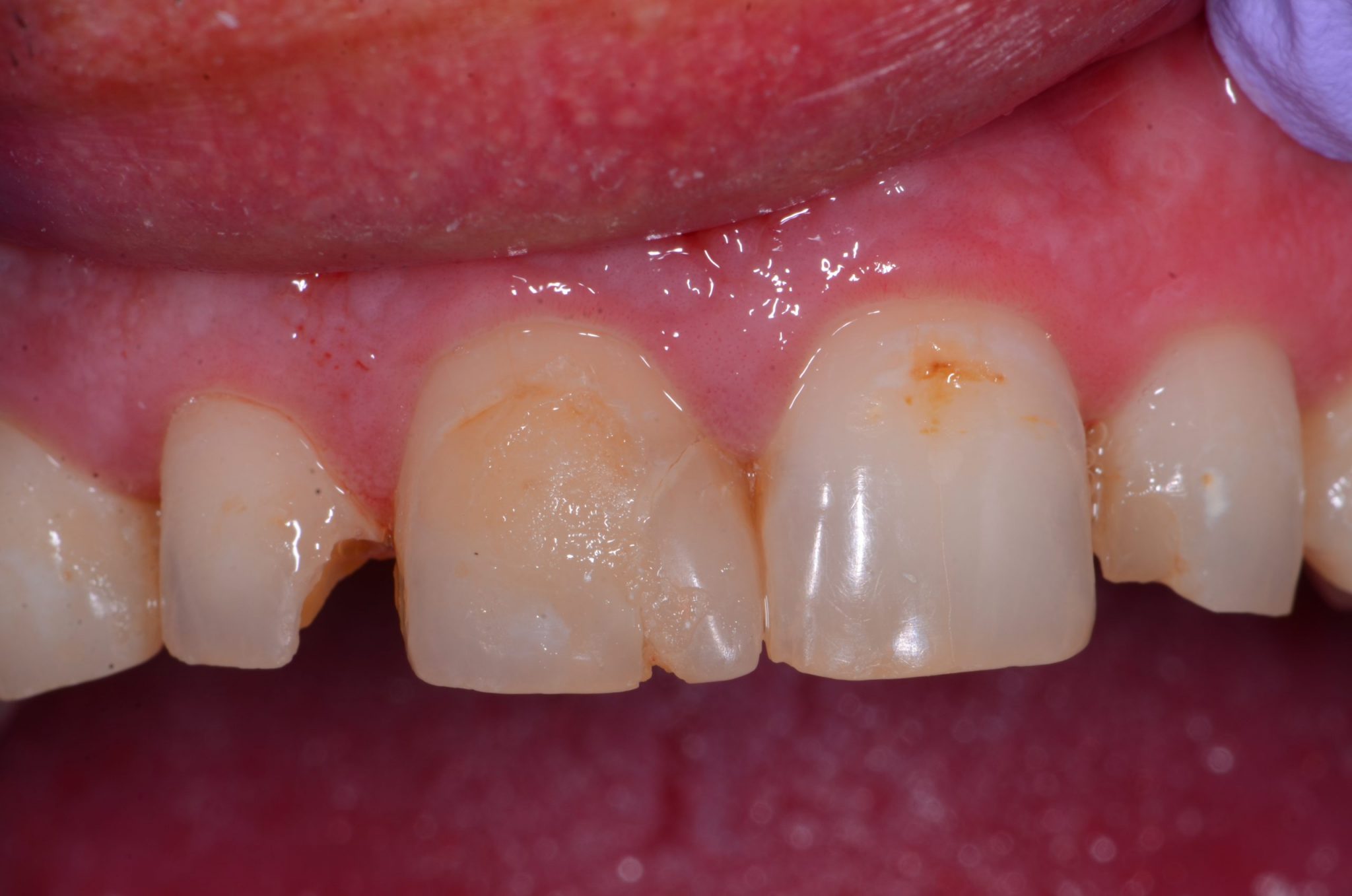 Fractured tooth before dental bonding