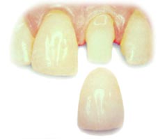 Porcelain crown being placed on a tooth