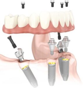 Illustration of all on four dental implants