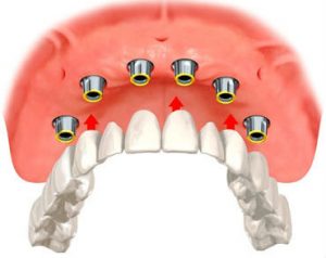 Implant overdentures illustation