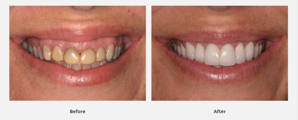 before and after tetracycline stains are treated.