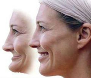 images of before and after facial collapse