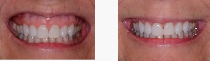 Botox gummy smile repair