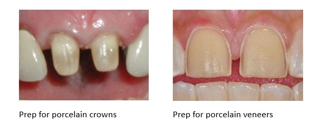Comparison of crowns to veneers tooth prep