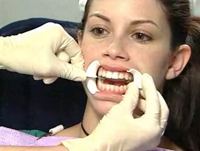 Retractors placed to expose and isolate the teeth before whitening