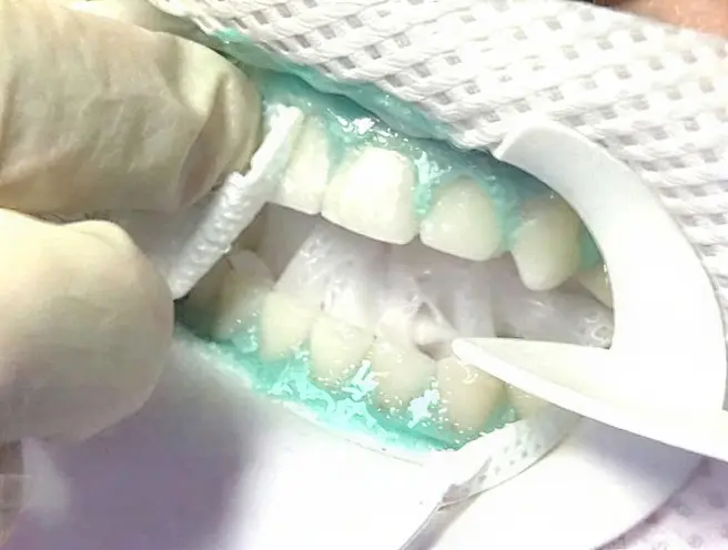 A protective napkin and gum barrier applied, then Zoom whitening gel on the teeth