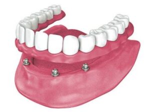 A snap-on denture
