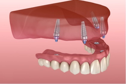 Implant supported dentures.